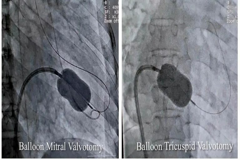 जबलपुर में विशेषज्ञों ने बैलून तकनीक से मिट्रल व ट्राइकसपिड वॉल्व की सिकुड़न का बिना सर्जरी के इलाज किया