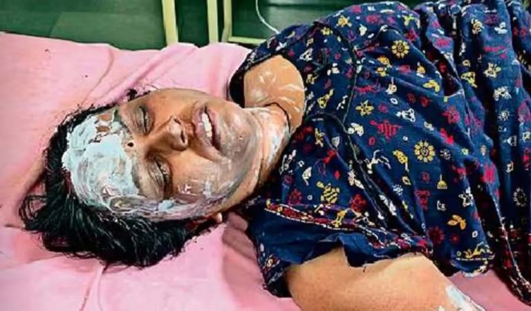 शिवपुरी : सिलाई के पैसों के विवाद में महिला टेलर ने पार्षद पर पेट्रोल छिड़ककर लगा दी आग