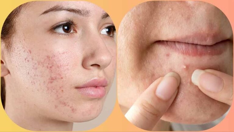 मुहांसे हटाने का ये उपाय पड़ सकता है भारी, चेहरे को पहुंचा सकता है नुकसान