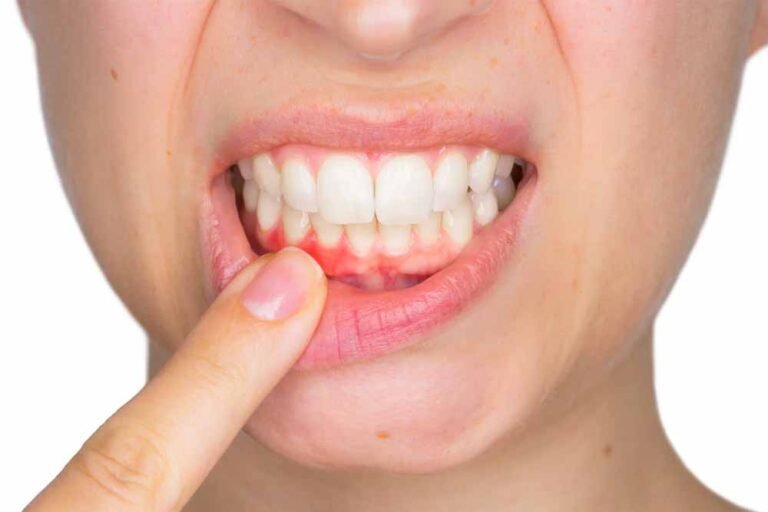 मसूड़ों से खून आने की समस्या को करें दूर, अपनाएं ये कारगर टिप्स