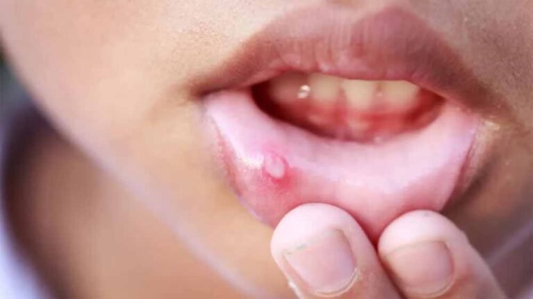 बार-बार होने वाले मुंह के छाले? अपनाएं ये सरल इलाज