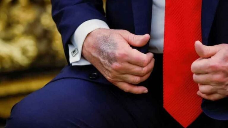 स्वास्थ्य को लेकर उठे सवाल, हाथ के निशान पर ट्रंप की सफाई—क्या है पूरा मामला?