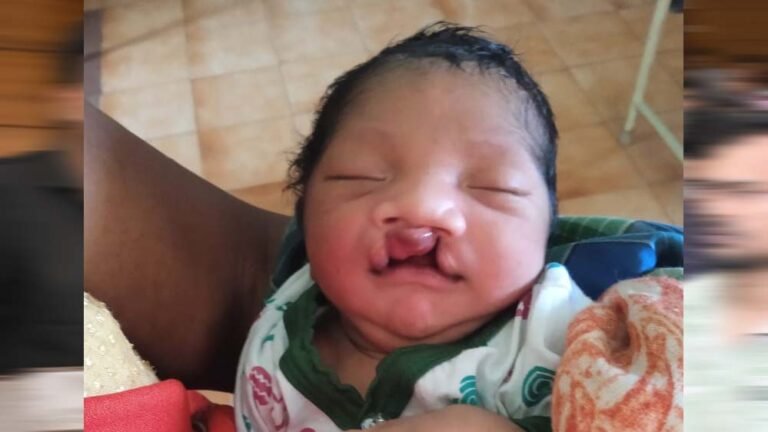 चिरायु टीम ने दिया एक परिवार को नया जीवन, जन्मजात विकृति से जूझ रहे बच्चे को मिली राहत  चिरायु टीम की मदद से एक बच्चे को मिला नया जीवन, जन्मजात विकृति से जूझते परिवार की उम्मीद जगी