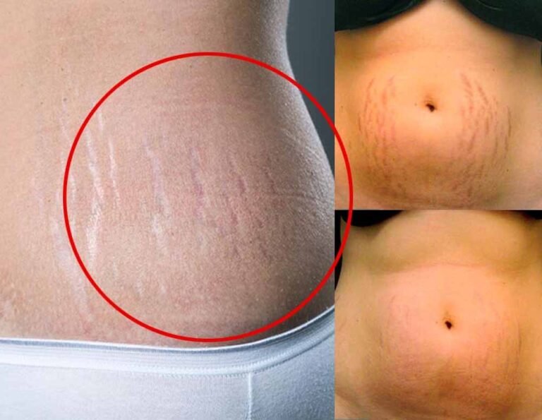 अब स्ट्रेच मार्क्स नहीं! घर पर ही अपनाएं ये घरेलू नुस्खे