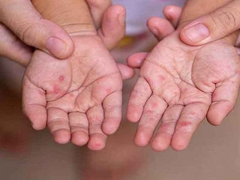मध्यप्रदेश में बढ़ा खसरे का खतरा: 4 जिलों में 12 केस मिले, स्वास्थ्य विभाग ने जारी किया अलर्ट