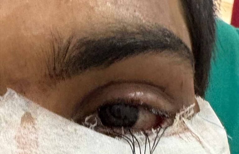 स्किन ग्राफ्टिंग से मरीज के पलक का सफल पुनर्निर्माण