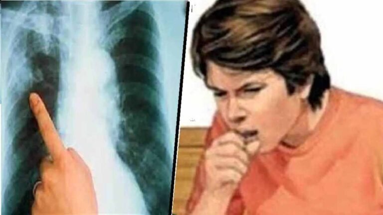 टीबी नियंत्रण अभियान में राजस्थान का बड़ा कदम, ग्रामीण अंचलों में बीमारी पर काबू
