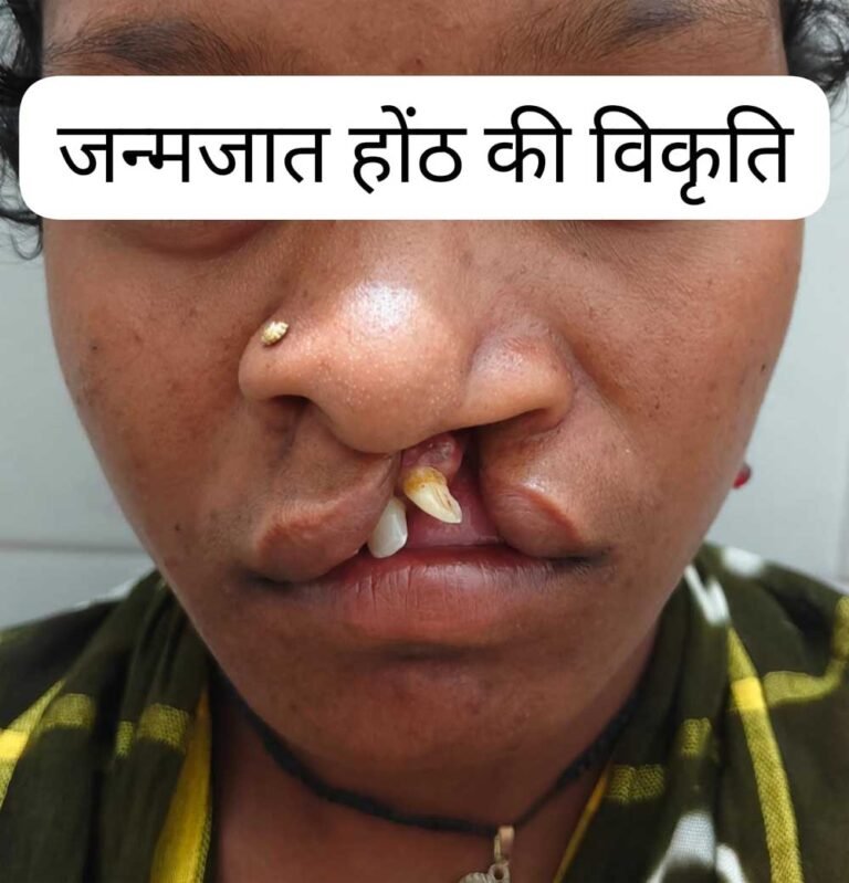 जन्मजात होंठ की विकृति का हुआ सफल उपचार, अब सामान्य जीवन जी रही हैं 22 वर्षीय युवती
