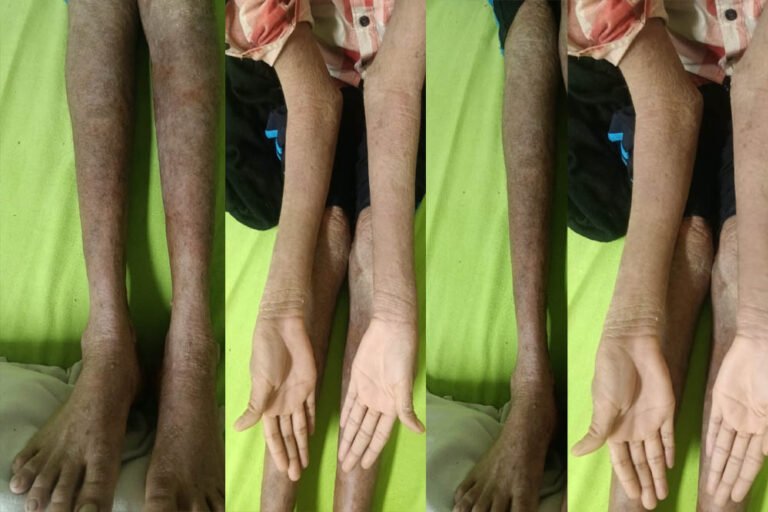 नामुमकिन हुआ मुमकिन! AIIMS रायपुर में ‘लाइलाज’ समझी जा रही बीमारी का सफल इलाज