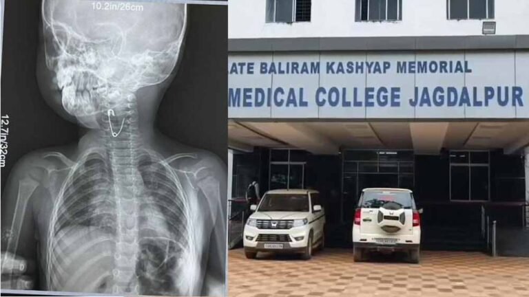 मेडिकल कॉलेज के डॉक्टरों की बड़ी सफलता, बच्ची के गले से दूरबीन पद्धति से निकाला सेफ्टी पिन
