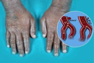 सिकल सेल को लेकर बस्तर में बड़ा अभियान, 6 लाख से अधिक लोगों की जांच